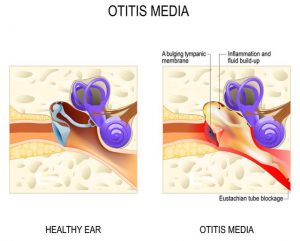 Zánět středního ucha